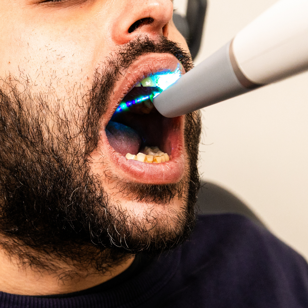 Partiële of frameprothese